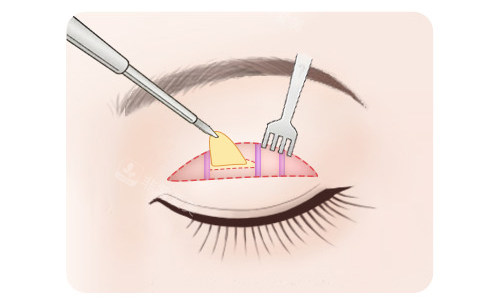 全切雙眼皮脂肪切除
