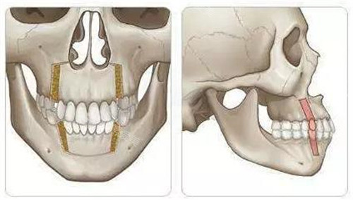 雙鄂手術(shù)方式前方和側(cè)方演示動畫圖