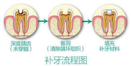 補牙流程圖示意圖