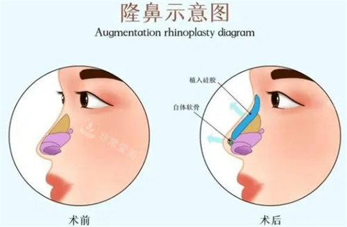 隆鼻前后對比