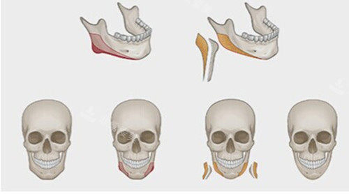 下頜骨外板整形卡通示意圖