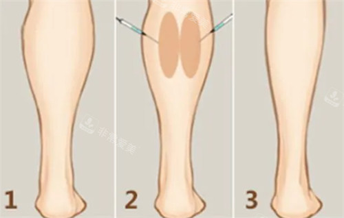 瘦腿注射前后變化