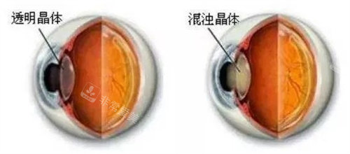 透明晶体和混浊晶体对比图