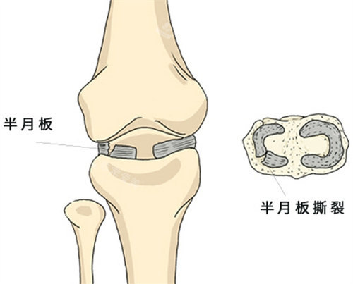 半月板撕裂圖示