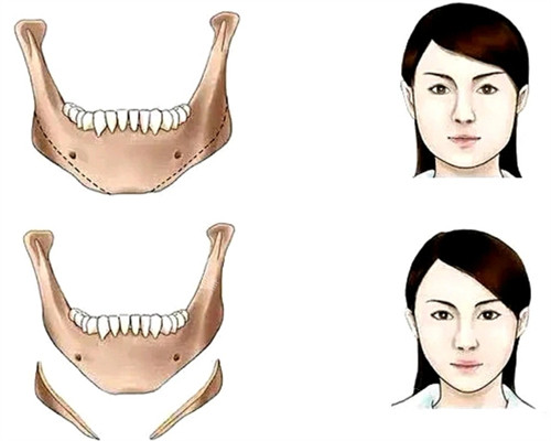 下頜骨手術(shù)前后對比和截取部分