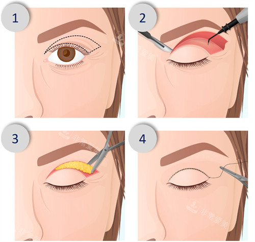 切開型雙眼皮手術(shù)過程