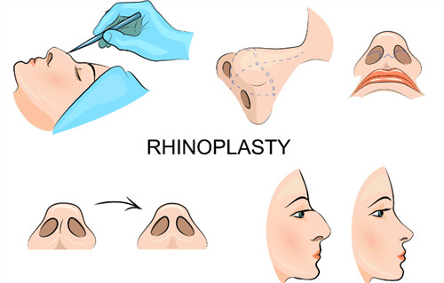 隆鼻過程圖示