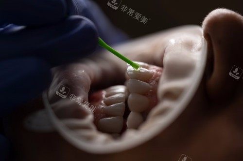 牙齿矫正示意图