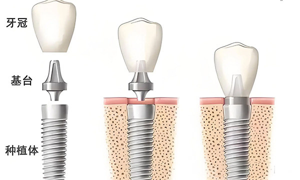 牙冠基台种植体种植牙
