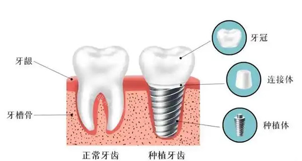 种植牙和正常牙齿照片