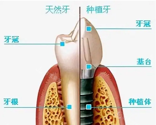 天然牙齿和种植牙对比