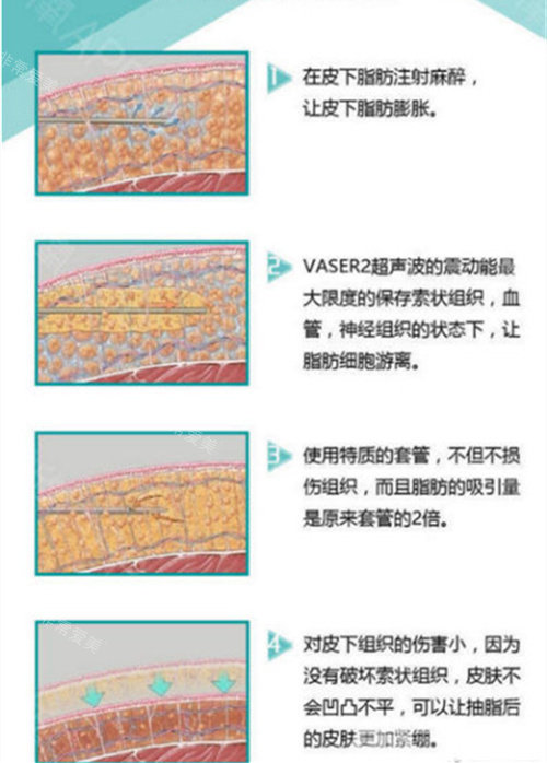 威塑手術(shù)機(jī)器與手術(shù)方式演示動(dòng)畫圖