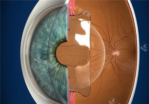 晶體植入近視手術模擬圖