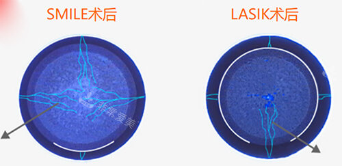 全飛秒和準(zhǔn)分子激光手術(shù)術(shù)后漫畫圖