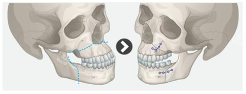 雙顎手術(shù)的前后對(duì)比