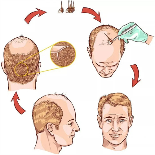 毛發(fā)種植手術(shù)過程圖