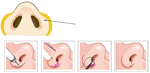 鼻翼縮小手術過程