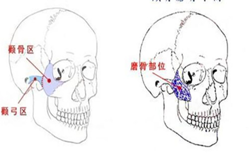 顴骨磨骨手術(shù)示意圖