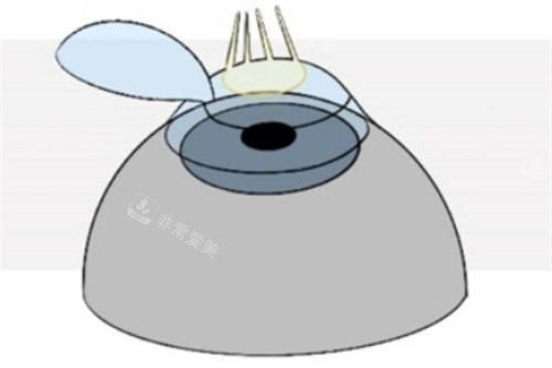 Refractive-Surgery-Techniques-1024x493_副本1
