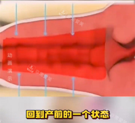 女性私密收紧针照片
