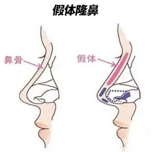 假體隆鼻對(duì)比 假體隆鼻對(duì)比