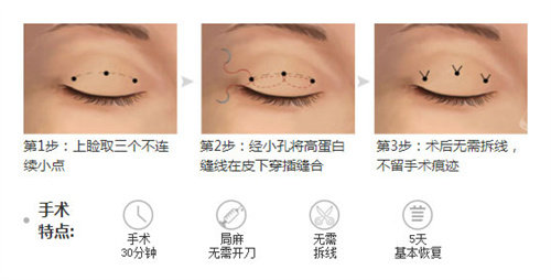 双眼皮三点术过程特点