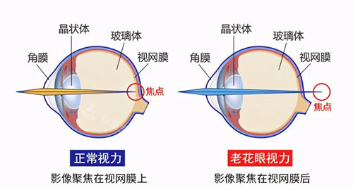 老花眼和正常视力