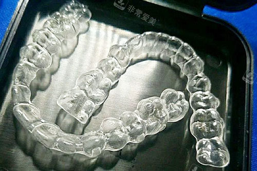 杭州名一口腔牙套实拍图
