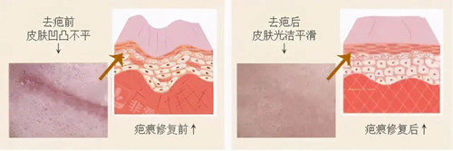 激光祛疤卡通示意圖 激光祛疤卡通示意圖