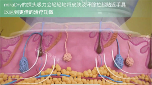 miraDry清新微波是什么