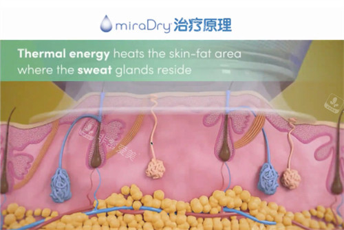 miraDry清新微波治疗原理