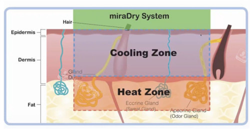 miraDry清新微波正规吗