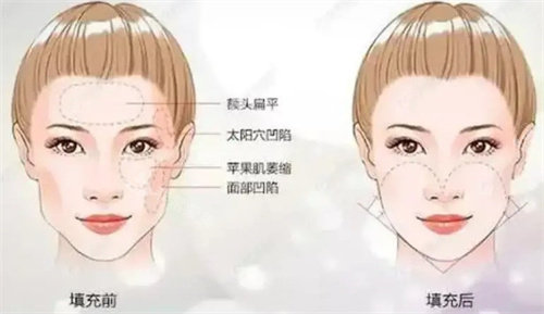 面頰填充術(shù)前后對(duì)比 面頰填充術(shù)前后對(duì)比