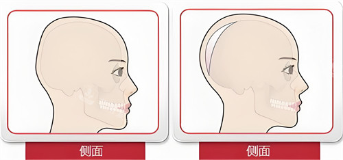 頭部填充側(cè)面對(duì)比動(dòng)畫圖 頭部填充側(cè)面對(duì)比動(dòng)畫圖