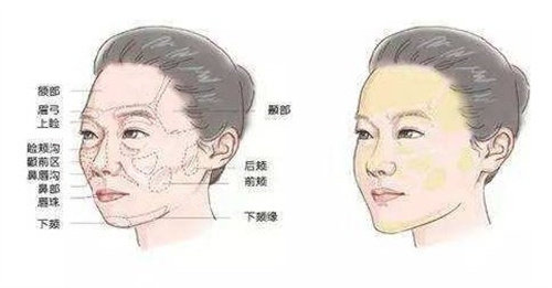 膠原蛋白面部填充前后 膠原蛋白面部填充前后