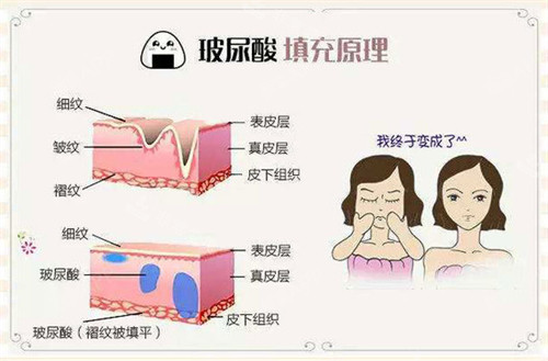 玻尿酸注射填充原理動(dòng)畫演示圖 玻尿酸注射填充原理動(dòng)畫演示圖