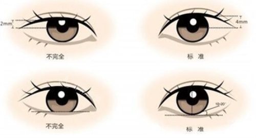 雙眼皮示意圖 雙眼皮示意圖