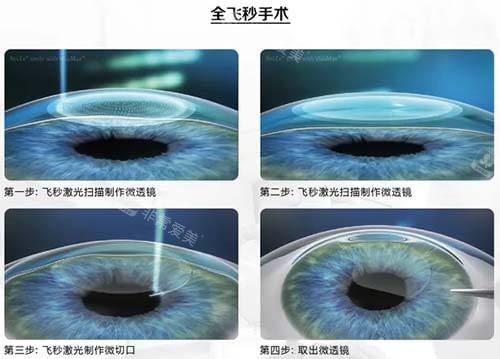 近视眼手术4