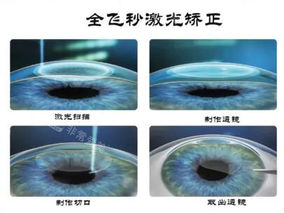 近视眼手术3