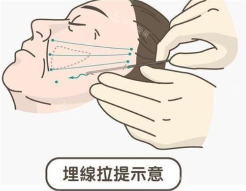 埋线提升面部的操作过程