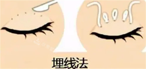 雙眼皮埋線怎么做的 雙眼皮埋線怎么做的