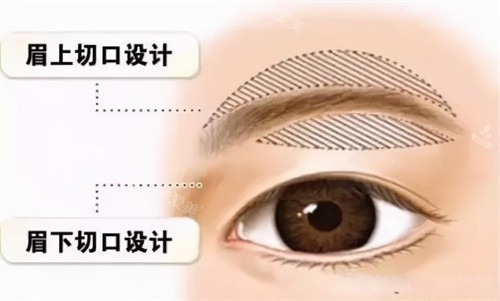 提眉手術(shù)切口動畫演示圖 提眉手術(shù)切口動畫演示圖