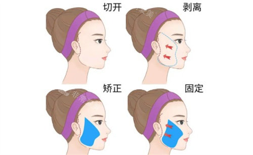拉皮手術(shù) 拉皮手術(shù)