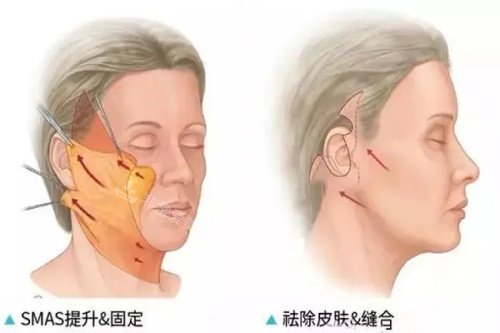 拉皮手術(shù) 拉皮手術(shù)