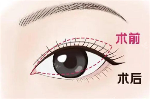 双眼皮修复手术对比