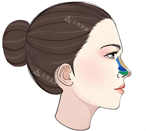 隆鼻修復(fù)圖 隆鼻修復(fù)圖