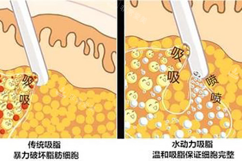 吸脂示意图 吸脂示意图