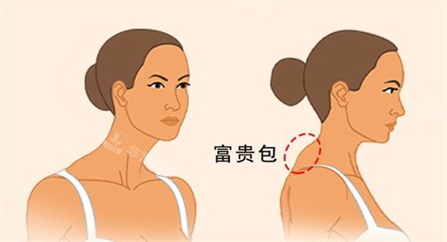 赣州富贵包哪里手术好?亚韩整形|田美医疗美容|韩美整形|叶子医疗美容治疗富贵包好且有名!