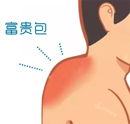 富贵包在身体的位置 富贵包在身体的位置