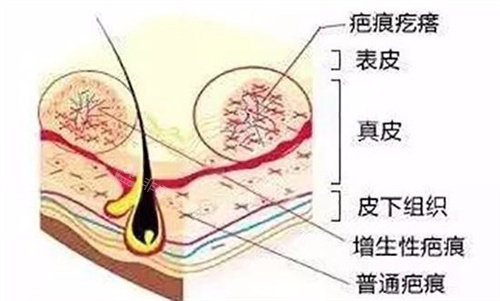 疤痕疙瘩皮膚解析圖 疤痕疙瘩皮膚解析圖